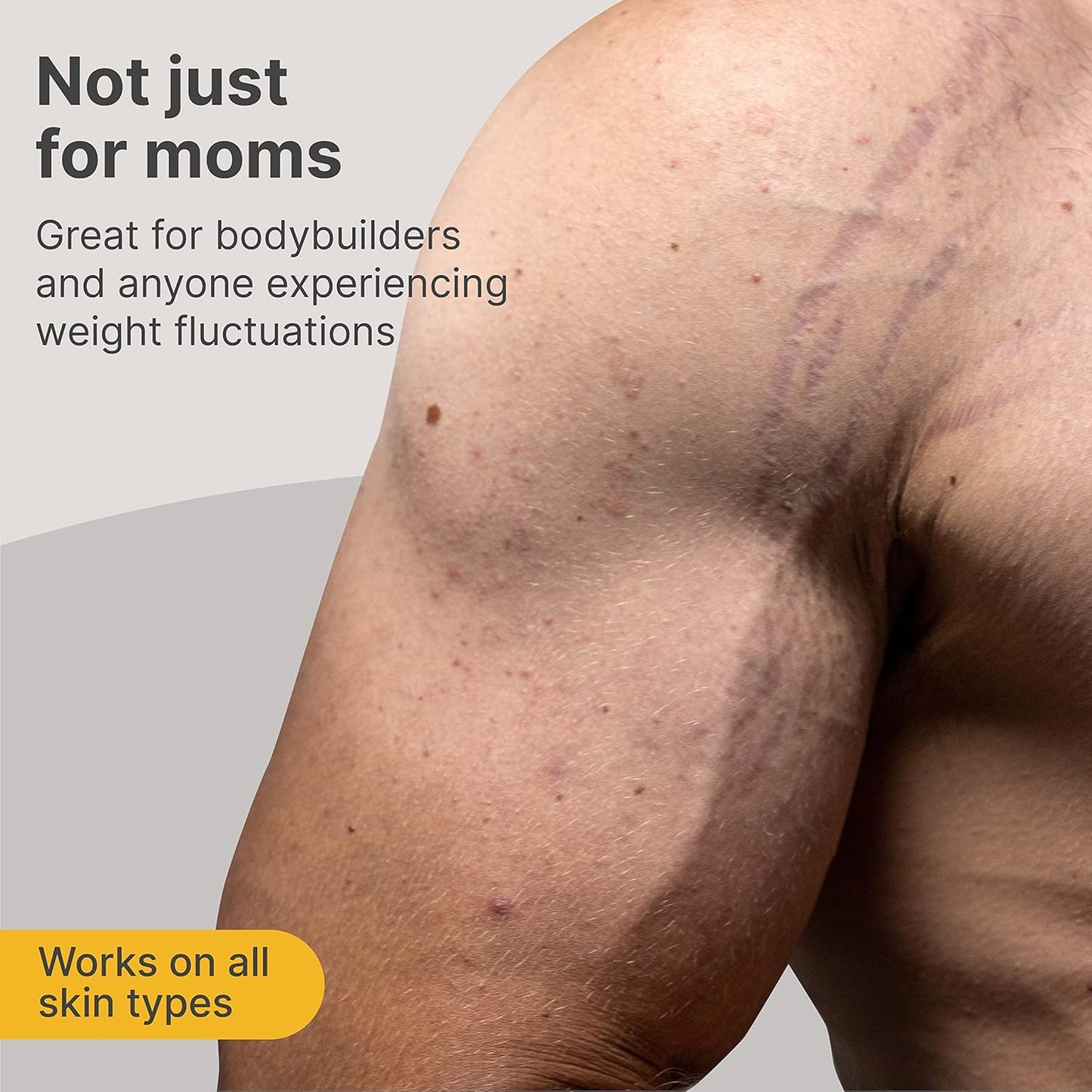 TriLASTIN-SR Intensive Stretch Mark Cream (5.5oz) Bundle with Nipple & Lip Balm (3pk) | Fast-Acting Stretch Marks Cream with Absorption Enhancing Serum | Breastfeeding & Ingesting Safe Balm